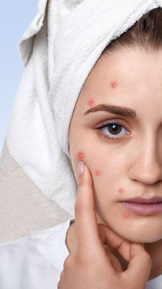9 Simple Lifestyle Changes To Prevent Acne Naturally