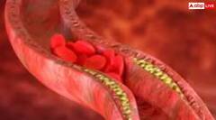 45 ਦੀ ਉਮਰ ਤੋਂ ਬਾਅਦ ਨਜ਼ਰ ਆਉਣ ਆਹ ਲੱਛਣ ਤਾਂ ਹੋ ਜਾਓ ਅਲਰਟ, ਹੋ ਸਕਦਾ ਹਾਈ ਕੋਲੈਸਟ੍ਰੋਲ