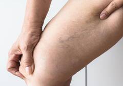 ये 6 कारण जिससे दिखने लगती हैं पैरों की नसें, कहीं आप तो नहीं हैं इनके शिकार