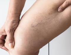 ਤੁਹਾਡੇ ਪੈਰਾ ਦੀਆਂ ਨਸਾਂ ਨਜ਼ਰ ਆਉਂਦੀਆਂ, ਕਿਤੇ ਤੁਹਾਨੂੰ ਵੀ ਤਾਂ ਨਹੀਂ ਹੋ ਗਈ ਆਹ ਬਿਮਾਰੀ