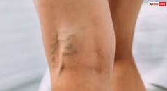 ਤੁਹਾਡੇ ਪੈਰਾ ਦੀਆਂ ਨਸਾਂ ਨਜ਼ਰ ਆਉਂਦੀਆਂ, ਕਿਤੇ ਤੁਹਾਨੂੰ ਵੀ ਤਾਂ ਨਹੀਂ ਹੋ ਗਈ ਆਹ ਬਿਮਾਰੀ