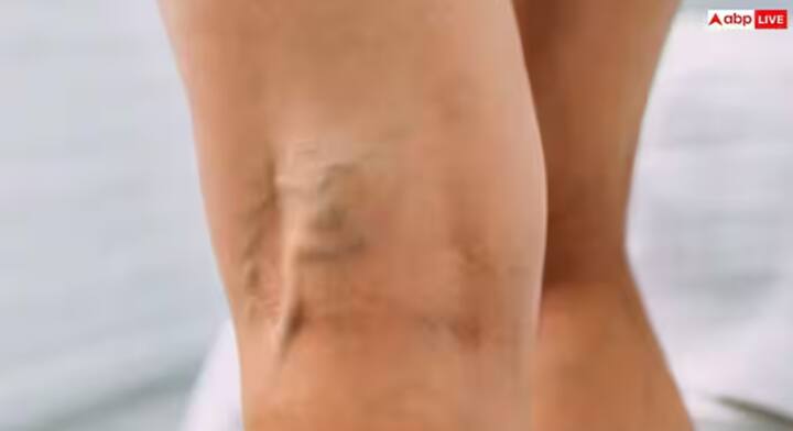 ਪੈਰਾਂ ਦੀਆਂ ਨਸਾਂ ਉਭਰ ਕੇ ਨਜ਼ਰ ਆਉਂਦੀਆਂ ਹਨ ਤਾਂ ਇਹ ਸਿਰਫ ਬਾਹਰੀ ਲੱਛਣ ਨਹੀਂ ਹਨ, ਇਹ ਇੱਕ ਗੰਭੀਰ ਸਮੱਸਿਆ ਹੋ ਸਕਦੀ ਹੈ।