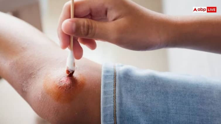 how to stop bleeding quickly mistake can be dangerous चोट लगने से आने लगे खून तो सबसे पहले करें ये काम, एक गलती भी हो सकती है खतरनाक