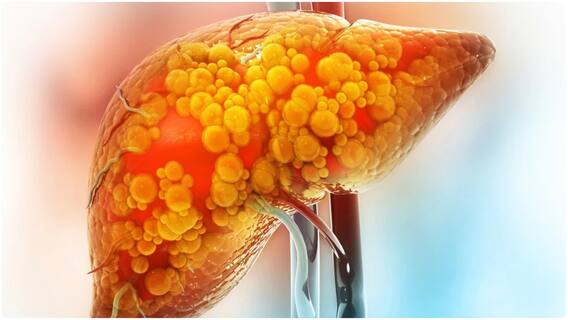 Non Alcoholic Fatty Liver : కాలేయంలో కొవ్వుకు కారణాలు ఇవే.. కంట్రోల్ చేయడానికి ఫాలో అవ్వాల్సిన చిట్కాలివే Non Alcoholic Fatty Liver : కాలేయంలో కొవ్వుకు కారణాలు ఇవే.. కంట్రోల్ చేయడానికి ఫాలో అవ్వాల్సిన చిట్కాలివే