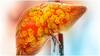 Non Alcoholic Fatty Liver : కాలేయంలో కొవ్వుకు కారణాలు ఇవే.. కంట్రోల్ చేయడానికి ఫాలో అవ్వాల్సిన చిట్కాలివే