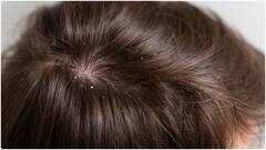 Home Remedies for Dandruff : చుండ్రును సహజంగా వదిలించుకోవాలంటే ఈ ఇంటి చిట్కాలు ఫాలో అయిపోండి
