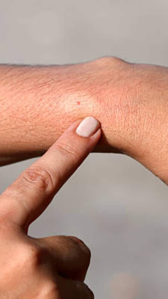 क्या मधुमक्खी के काटने से हो सकती है मौत?