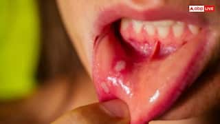 मुंह में छाले होना भी हो सकता है कैंसर का लक्षण? जानकर हैरान रह जाएंगे आप