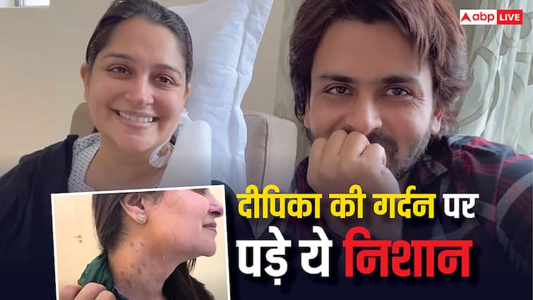 हॉस्पिटल में बिताई दर्दभरी रातें, गर्दन पर पड़े निशान, लिवर कैंसर सर्जरी के बाद Dipika Kakar Ibrahim का हुआ ऐसा हाल