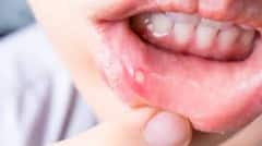 ਸਾਵਧਾਨ! ਮੂੰਹ 'ਚ ਅਲਸਰ ਜਾਨਲੇਵਾ ਬਿਮਾਰੀ ਕੈਂਸਰ ਵੱਲ ਇਸ਼ਾਰਾ, ਜਾਣੋ ਕਿਵੇਂ ਵੱਧਦਾ ਮੌਤ ਦਾ ਖਤਰਾ ? ਲੱਛਣ ਜਾਣ ਕਰੋ ਬਚਾਅ