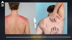 ਗਰਮੀ ਕਾਰਨ ਪਿੱਠ 'ਤੇ ਹੋਈ ਪਿੱਤ ਤੋਂ ਮਿਲੇਗਾ ਛੁਟਕਾਰਾ, ਬਸ ਅਪਲਾਈ ਕਰੋ ਇਹ ਘਰੇਲੂ ਨੁਸਖੇ