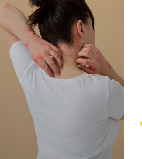 ਗਰਮੀ ਅਤੇ ਪਸੀਨੇ ਕਾਰਨ ਕਈ ਵਾਰੀ ਪਿੱਠ ਜਾਂ ਸਰੀਰ ਦੇ ਹੋਰ ਹਿੱਸਿਆਂ 'ਤੇ ਪਿੱਤ ਨਿਕਲ ਆਉਂਦੀ ਹੈ। ਇਸ ਨਾਲ ਚਮੜੀ 'ਤੇ ਲਾਲੀ, ਧੱਫੜ ਜਾਂ ਖਾਰਸ਼ ਹੋ ਜਾਂਦੀ ਹੈ। ਦਿਨ ਦਾ ਆਰਾਮ ਤੇ ਰਾਤ ਦੀ ਨੀਂਦ ਵੀ ਪ੍ਰਭਾਵਿਤ ਹੋ ਸਕਦੀ ਹੈ। ਇਲਾਜ ਲਈ ਦਵਾਈਆਂ ਦੇ ਨਾਲ ਕੁਝ ਘਰੇਲੂ ਉਪਾਅ ਵੀ ਲਾਭਦਾਇਕ ਸਾਬਤ ਹੋ ਸਕਦੇ ਹਨ।