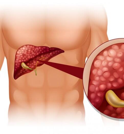 ਜਦੋਂ ਜਿਗਰ ਵਿੱਚ ਪਾਣੀ ਭਰਨਾ ਸ਼ੁਰੂ ਹੋ ਜਾਂਦਾ ਹੈ ਤਾਂ ਸਰੀਰ ਵਿੱਚ ਕਈ ਤਰ੍ਹਾਂ ਦੇ ਲੱਛਣ ਨਜ਼ਰ ਆਉਂਦੇ ਹਨ। ਸਭ ਤੋਂ ਪਹਿਲਾਂ ਵਜ਼ਨ ਤੇਜ਼ੀ ਨਾਲ ਵਧਣ ਲੱਗਦਾ ਹੈ, ਕਿਉਂਕਿ ਸਰੀਰ ਵਿੱਚ ਪਾਣੀ ਇਕੱਠਾ ਹੋਣ ਲੱਗਦਾ ਹੈ। ਇਸ ਨਾਲ ਪੇਟ 'ਚ ਦਬਾਅ, ਦਰਦ ਜਾਂ ਭਰਾਪਣ ਜਿਹਾ ਮਹਿਸੂਸ ਹੋਣ ਲੱਗਦਾ ਹੈ। ਇਹ ਸਭ ਲੱਛਣ ਜਿਗਰ 'ਚ ਪਾਣੀ ਭਰਨ ਦੀ ਸਮੱਸਿਆ ਵੱਲ ਇਸ਼ਾਰਾ ਕਰਦੇ ਹਨ, ਜਿਸ ਦਾ ਸਮੇਂ ਸਿਰ ਇਲਾਜ ਕਰਵਾਉਣਾ ਬਹੁਤ ਜ਼ਰੂਰੀ ਹੁੰਦਾ ਹੈ।