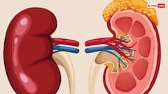 किडनी से जुड़ी 6 गलतफहमियां, आपने भी सुनी होगी...जानिए क्या है सच्चाई