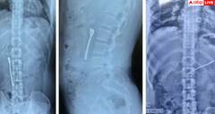 ਦਵਾਈ ਦੇ ਨਾਲ ਸਟੀਲ ਦਾ ਚਮਚਾ ਵੀ ਖਾ ਗਿਆ ਵਿਅਕਤੀ, ਜਾਣੋ ਕਿਵੇਂ ਡਾਕਟਰਾਂ ਨੇ ਕੱਢਿਆ ਬਾਹਰ?