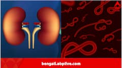 ডোনারের শরীরে প্যারাসাইটের বাসা, কিডনি প্রতিস্থাপনের পর রোগীর প্রাণ নিয়ে টানাটানি