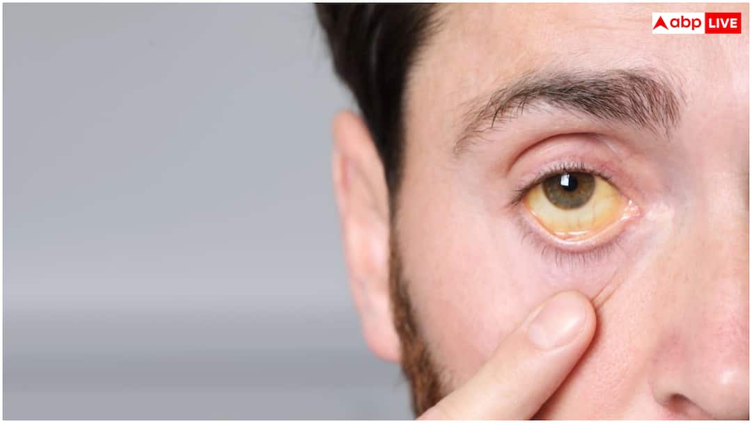 Why eyes and nails turn yellow during jaundice पीलिया होने पर आंखें और नाखून क्यों पड़ जाते हैं पीले? ये है वजह