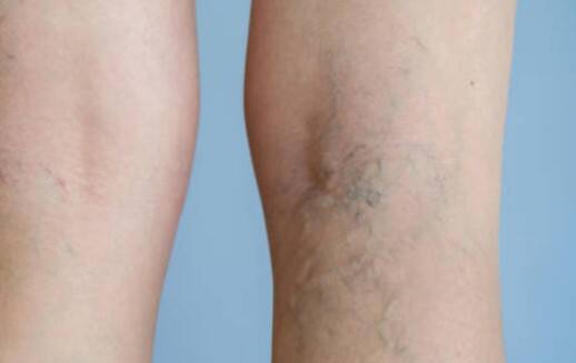 अचानक पैरों पर क्यों दिखते हैं निशान: पैरों पर दिखने वाले निशान जैसे कि नीले या लाल रंग के धब्बे, बिना किसी चोट के भी उभर सकते हैं. यह संकेत है कि आपके रक्त संचार या लिवर के साथ कुछ गड़बड़ हो सकती है.