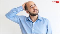 सिर पर जगह-जगह दिखने लगे गंजेपन के पैच तो न हो परेशान, दोबारा ऐसे उगा सकते हैं बाल