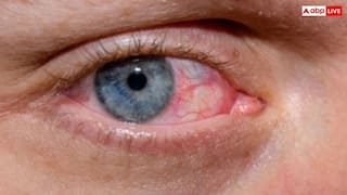 आंखों से पहचानें फैटी लिवर के लक्षण, समय रहते हो जाएं सतर्क