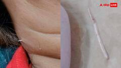 अब से कभी नहीं खाएंगे मछली! महिला के गले में दो हफ्ते फंसी रही मछली की हड्डी, फिर ऐसे आई बाहर