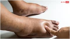 फोम की तरह धंसने लगी पैर की स्किन तो हो गई यह दिक्कत, तुरंत भागें डॉक्टर के पास