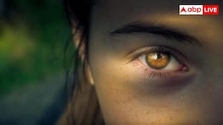 आंखों के नीचे डार्क सर्कल्स क्यों होते हैं? जानिए कारण, इलाज और बचाव के तरीके