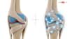Goodbye Painkillers? A New Wave Of Joint Repair Therapies Aims To Heal, Not Mask Pain