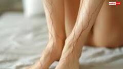 पैरों पर बनने लगे हैं मकड़ी जैसे जाले तो हो जाएं सावधान, इस खतरनाक बीमारी का है लक्षण