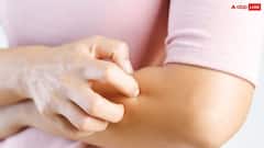 खुजली वाली त्वचा का देसी इलाज, राहत दिलाएंगे ये 6 घरेलू नुस्खे