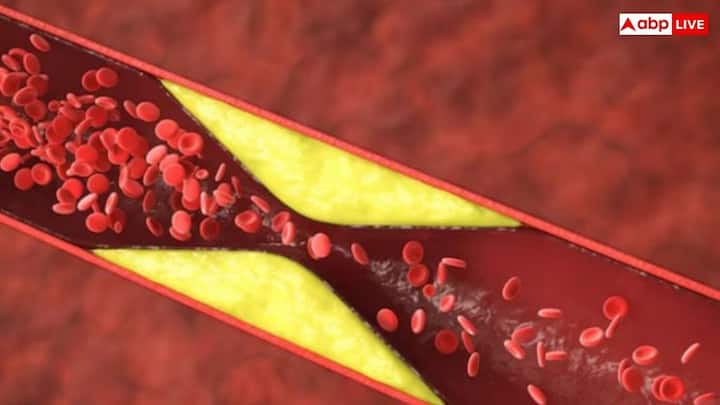 Cholesterol: উচ্চ কোলেস্টেরল চোখের সমস্যাও সৃষ্টি করে। চোখে দেখা যায় এই প্রাথমিক লক্ষণগুলি। কখন সতর্ক হবেন তা জেনে নিন।