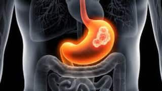 Gastric Cancer Warning: जेन झी पिढीला 'या' दुर्धर आजाराचा धोका, 2008 ते 2017 या काळात जन्म झालाय, तर ही बातमी नक्की वाचा