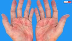 हाथ पर भी दिखते हैं फैटी लिवर के लक्षण, पता लगते ही भागें डॉक्टर के पास