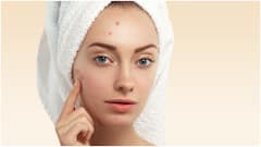 Home Remedies for Pimples : మొటిమలు తగ్గించడానికి బెస్ట్ ఇంటి చిట్కాలు.. మళ్లీ రాకూడదంటే ఫాలో అయిపోండి