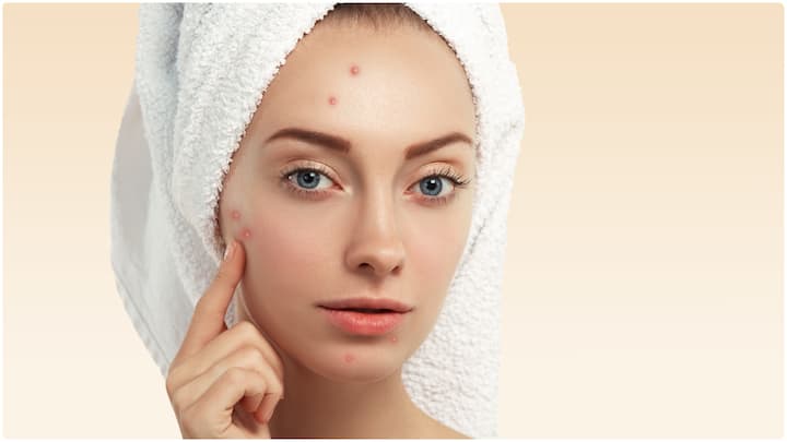 Best Home Remedies for Pimples : మొటిమలు తగ్గించుకునేందుకు ఇంట్లోనే ఎన్నో చిట్కాలు అందుబాటులో ఉంటాయి. వాటిలో బెస్ట్ ఏంటో ఇప్పుడు తెలుసుకుందాం.