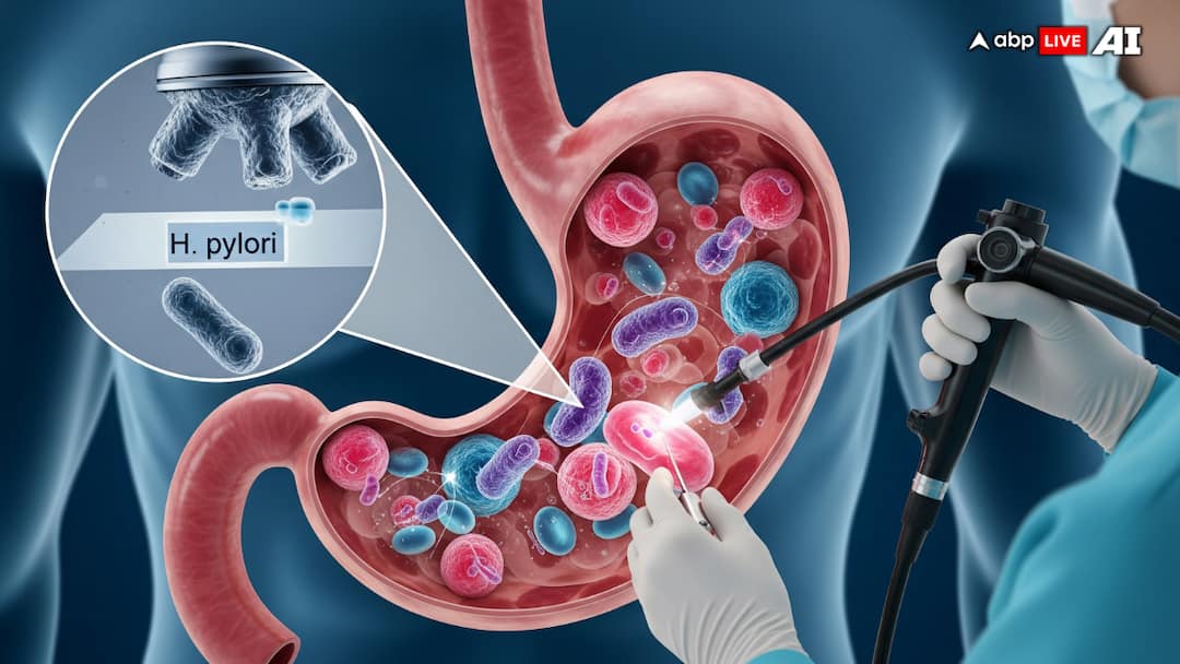 India Gastric Cancer Surge Risk Study Warns India Is Staring At A Gastric Cancer Surge, New Study Warns