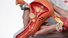 क्या पीसीओएस होने पर प्रेगनेंसी में आती है परेशानी, इसे ठीक कैसे किया जा सकता है