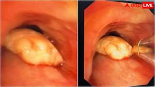 महिला की सांस की नली में फंस गया काजू, AIIMS के डॉक्टरों ने ऐसे बचाई जान