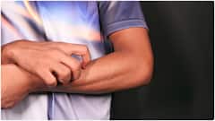 Best Remedies for Itching : దద్దుర్లను ఈ ఇంటి చిట్కాలతో దూరం చేసుకోండి.. దురద మాయమే ఇక