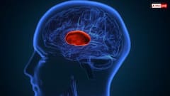 ब्रेन हैमरेज होने के कितने देर तक जिंदा रहता है इंसान, जानें सबसे पहले क्या करें