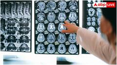 कैसे पता लगता है कि किसी को हो गया ब्रेन ट्यूमर? 99 पर्सेंट लोग अक्सर इग्नोर कर देते हैं ये 5 लक्षण