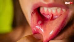 मुंह के छालों से मिलेगा छुटकारा,  ये 5 घरेलू नुस्खे देंगे झटपट आराम