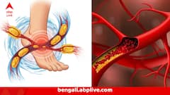 লাগামছাড়া খারাপ কোলেস্টেরল, জানান দেবে হাত-পায়ের এই লক্ষণগুলোই