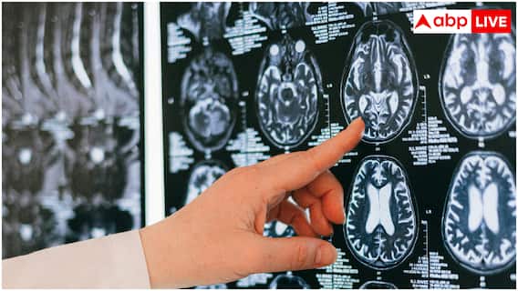 स्ट्रोक और डिमेंशिया से ब्रेन रहेगा एकदम सेफ, एम्स के डॉक्टर ने बताए 5 रामबाण तरीके