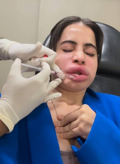 ਮਸ਼ਹੂਰ ਅਦਾਕਾਰਾ ਦਾ ਸੁੱਜਿਆ ਮੂੰਹ, ਬੁੱਲ੍ਹਾਂ 'ਤੇ ਲਗਵਾਏ ਟੀਕੇ; ਹੋਇਆ ਬੁਰਾ ਹਾਲ...