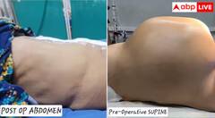 ਢਿੱਡ ‘ਚ ਬਣਿਆ 10.6 ਕਿਲੋ ਦਾ ਟਿਊਮਰ, ਡਾਕਟਰਾਂ ਦੇ ਉੱਡੇ ਹੋਸ਼, ਫਿਰ ਜੋ ਹੋਇਆ ਤੁਹਾਡੀ ਵੀ ਕੰਬ ਜਾਵੇਗੀ ਰੂਹ