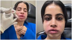 ‘It Was So Painful’: Uorfi Javed Shares Raw Video After Filler Removal; WATCH