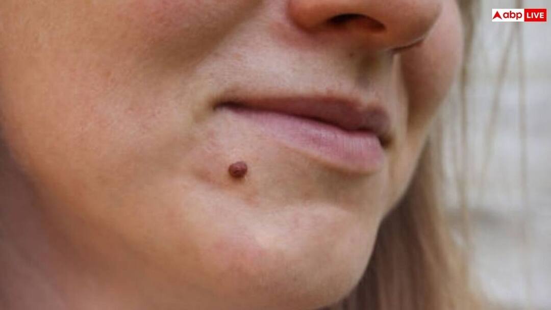 why warts appear on body know the treatment शरीर में क्यों निकलने लगते हैं मस्से, कब होती है खतरे की घंटी; जानिए इलाज