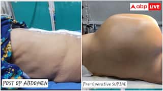 पेट में 10.6 किलो का ट्यूमर देख उड़े डॉक्टरों के होश, 6 घंटे की सर्जरी कर हटाया