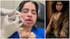 Urfi Javed on Lip Fillers : బెడిసి కొట్టిన లిప్ ఫిల్లర్ ట్రీట్​మెంట్.. గుర్తు పట్టలేనంతగా మారిపోయిన ఉర్ఫీ జావేద్ ఫేస్, కారణమిదే